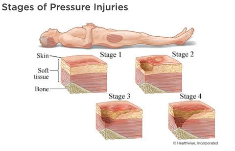 Stages of Pressure Injuries 